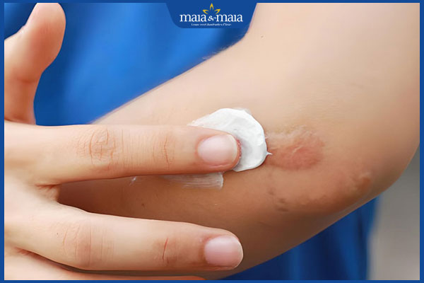 Sẹo lồi có mủ do đâu? Dấu hiệu nhận biết và cách điều trị 4 bôi thuốc sẹo lồi