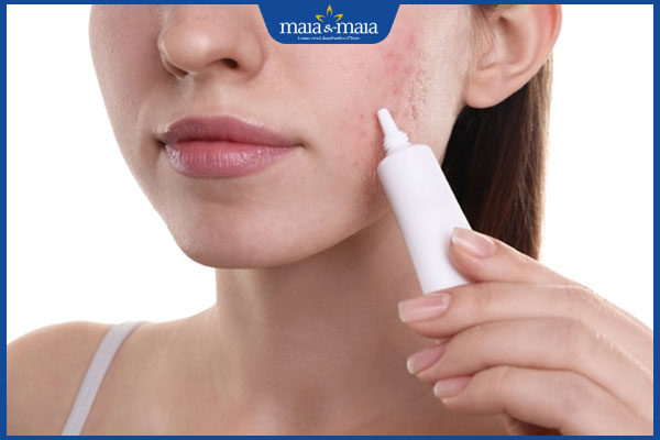 Sẹo lõm trên trán: Dấu hiệu nhận biết và phương pháp điều trị 3 bôi thuốc trị sẹo