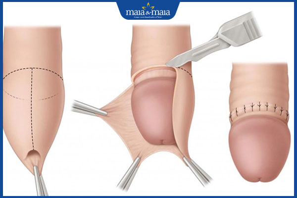 Sẹo lồi bao quy đầu do đâu? Cách chẩn đoán và điều trị hiệu quả 2 cắt bao quy đầu