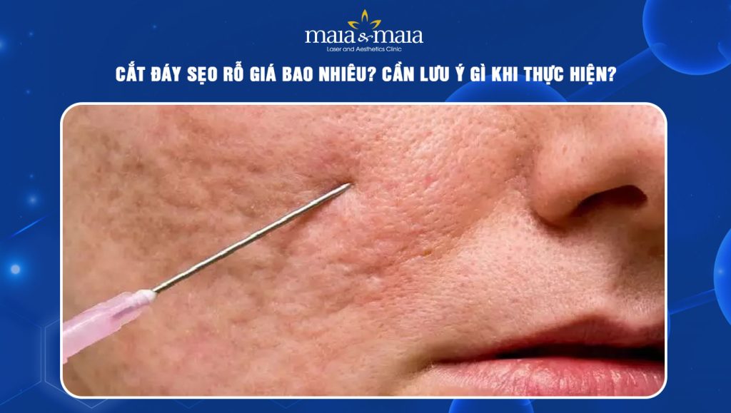 cắt đáy sẹo rỗ giá bao nhiêu