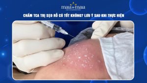 chấm TCA trị sẹo rỗ