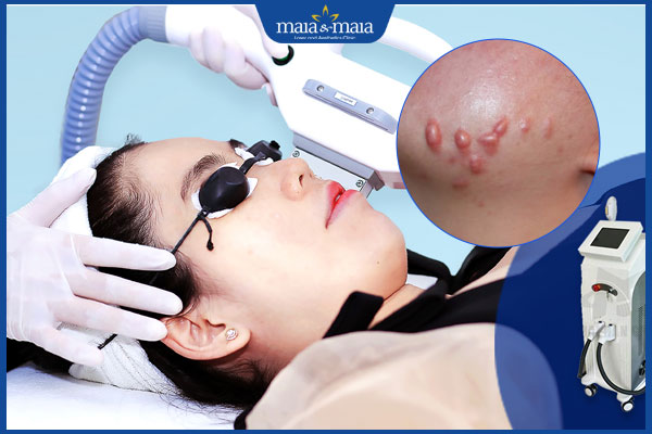 chi phí trị sẹo lồi