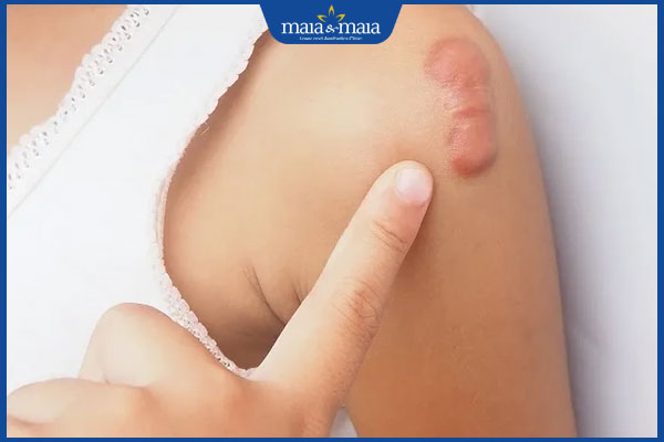 đặc điểm sẹo lồi