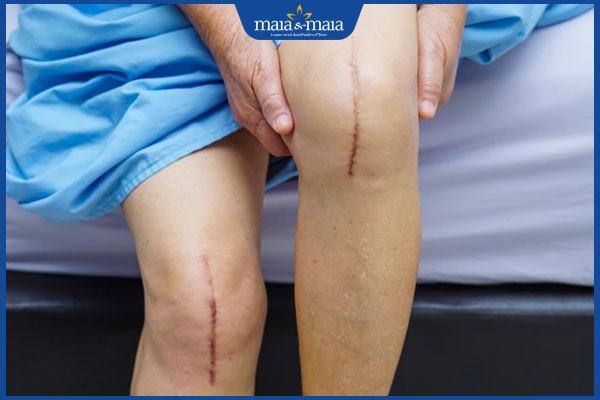 đầu gối bị sẹo lồi