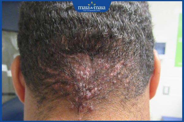 Viêm nang lông dạng sẹo lồi có triệu chứng gì? Gợi ý điều trị 2 dấu hiệu viêm nang lông sẹo lồi