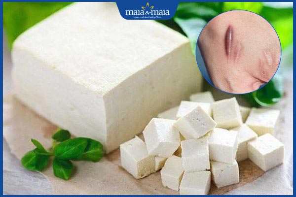 Ăn đậu phụ có bị sẹo lồi không? Bí quyết ngăn ngừa sẹo lồi 2 đậu phụ