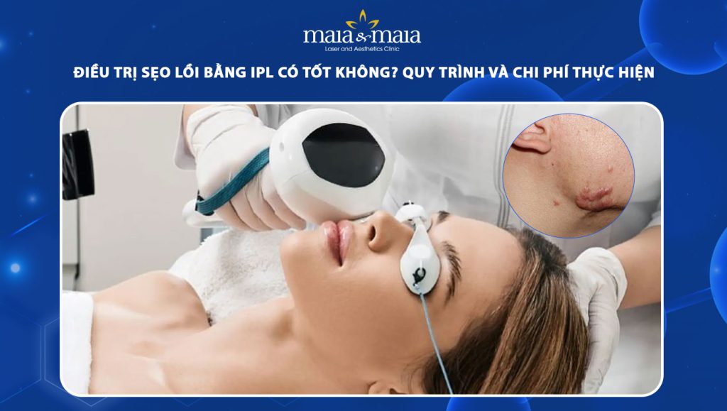 điều trị sẹo lồi bằng ipl