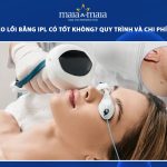 điều trị sẹo lồi bằng ipl