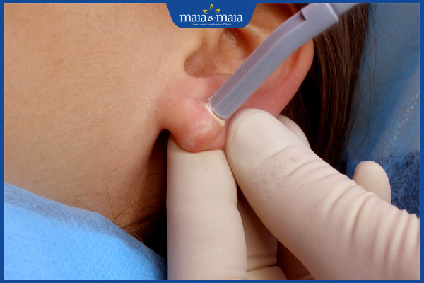 Sẹo lồi ở tai: Phương pháp điều trị và phòng ngừa hiệu quả 4 điều trị sẹo ở tai