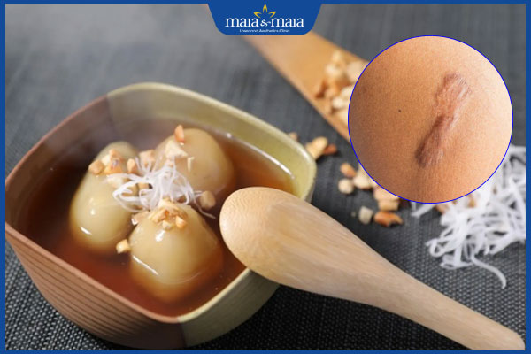 Ăn đồ nếp có bị sẹo lồi không? Những thực phẩm dễ để lại sẹo 2 đồ nếp gây nên sẹo lồi