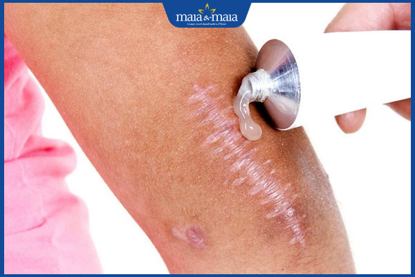 Sẹo lồi có mủ do đâu? Dấu hiệu nhận biết và cách điều trị 5 dưỡng ẩm sẹo lồi