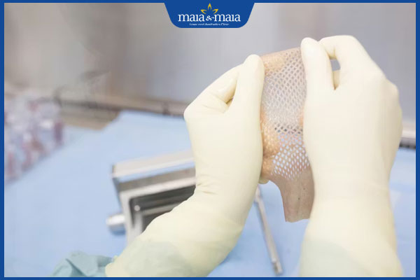 Ghép da trị sẹo lồi có tốt không? Quy trình và chi phí thực hiện 2 ghép da