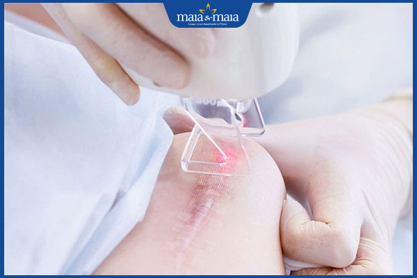 Trị sẹo lồi bằng laser có tốt không? Quy trình và chi phí thực hiện 5 giá laser trị sẹo lồi