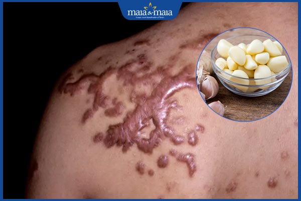 hiệu quả tỏi trị sẹo lồi