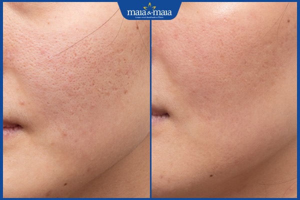 hiệu quả trị sẹo rỗ