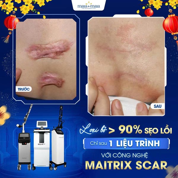 khách trị sẹo lồi co kéo