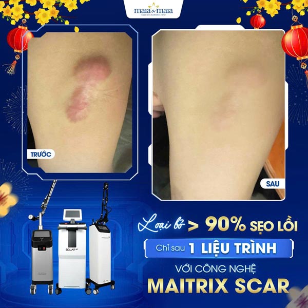 khách trị sẹo lồi đầu gối