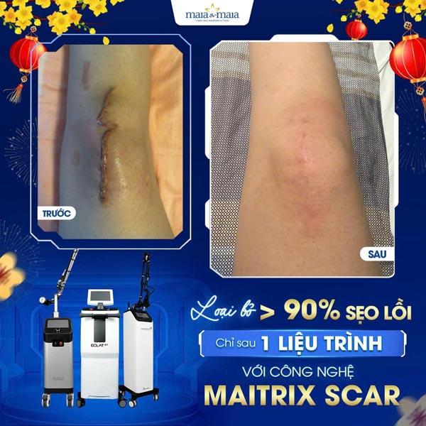 khách trị sẹo lồi ở chân