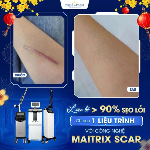 khách trị sẹo lồi ở tay