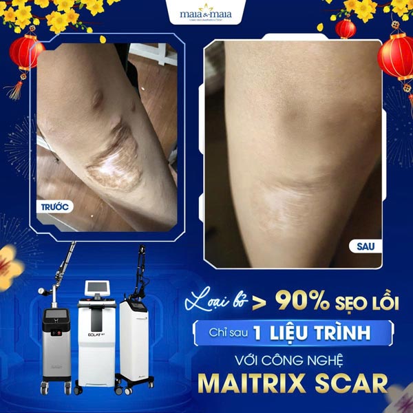 khách trị sẹo xấu