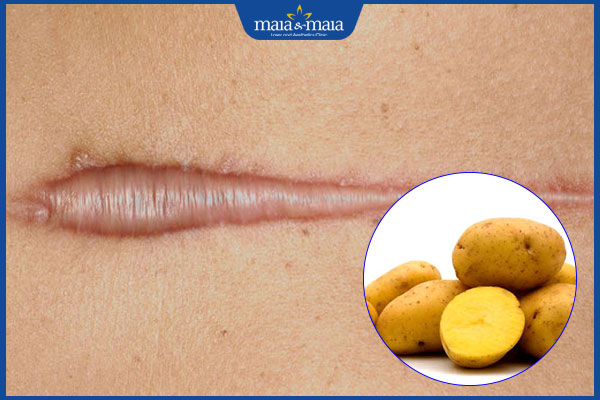 Ăn khoai tây có bị sẹo lồi không? Bí quyết dinh dưỡng khoa học 2 khoai tây
