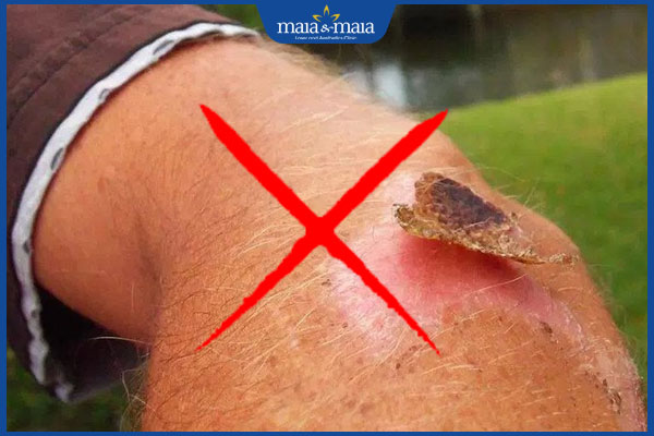 Ăn đu đủ có bị sẹo lồi không? Hướng dẫn ăn đúng cách 4 không bóc vảy