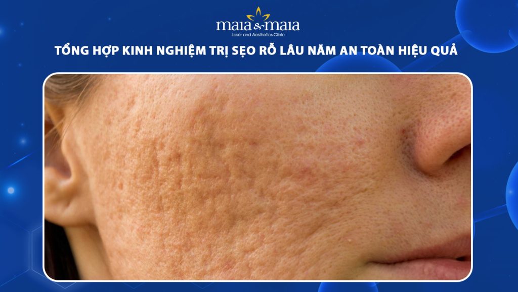kinh nghiệm trị sẹo rỗ lâu năm