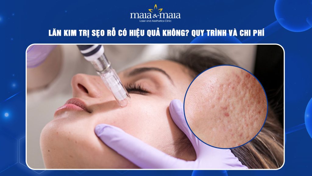 lăn kim trị sẹo rỗ