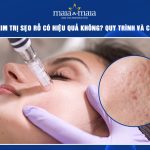 lăn kim trị sẹo rỗ