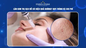 lăn kim trị sẹo rỗ