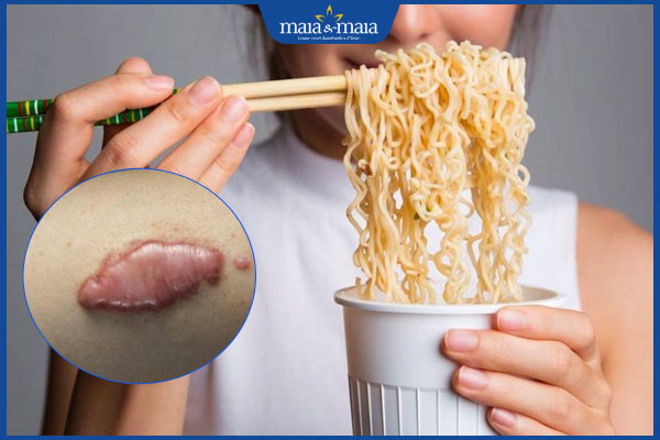 Ăn mì tôm có bị sẹo lồi không? Cần tránh ăn gì ngừa sẹo lồi? 2 mì tôm