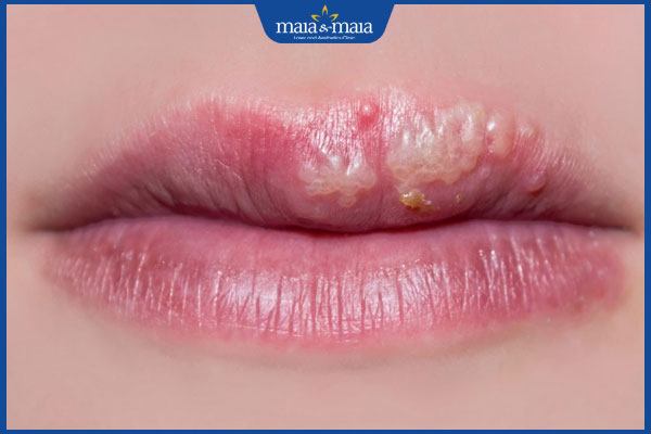 Sau phun môi bị sẹo phải làm sao? Bí kíp phòng ngừa sẹo xấu 2 môi bị viêm