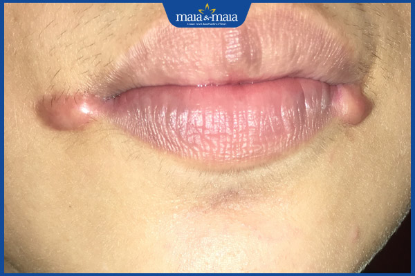 Đặc điểm sẹo lồi ở môi và phương pháp điều trị hiệu quả 2 môi có sẹo lồi