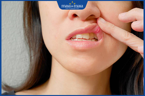 Đặc điểm sẹo lồi ở môi và phương pháp điều trị hiệu quả 3 môi đau ngứa