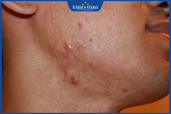 mụn phát triển thành sẹo lồi