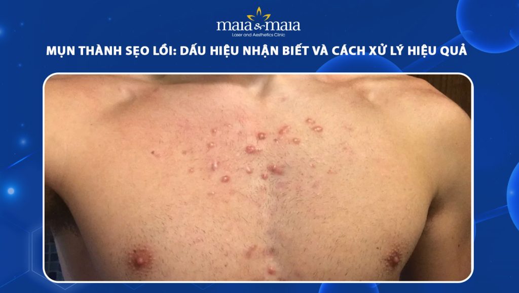 mụn thành sẹo lồi