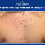 mụn thành sẹo lồi