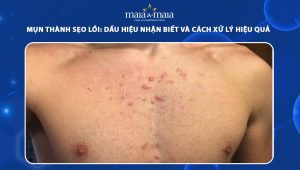 mụn thành sẹo lồi