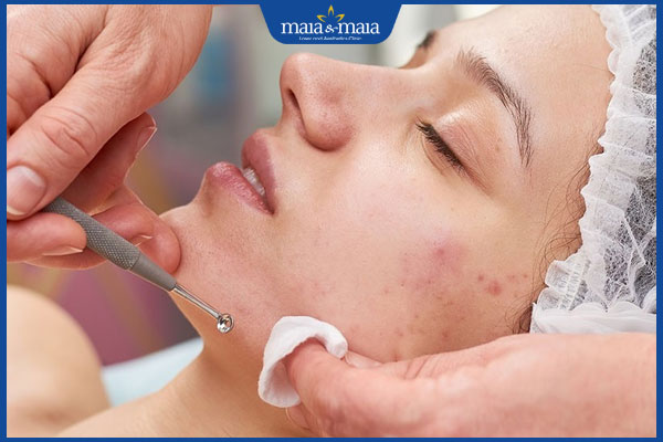 Nặn mụn có bị rỗ không? Hướng dẫn cách lấy nhân mụn an toàn 3 nặn mụn chuẩn y khoa