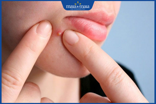 Nặn mụn có bị rỗ không? Hướng dẫn cách lấy nhân mụn an toàn 2 nặn mụn