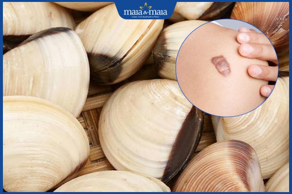 Ăn nghêu có bị sẹo lồi không? Top thực phẩm dễ gây sẹo cần kiêng 2 nghêu gây sẹo lồi