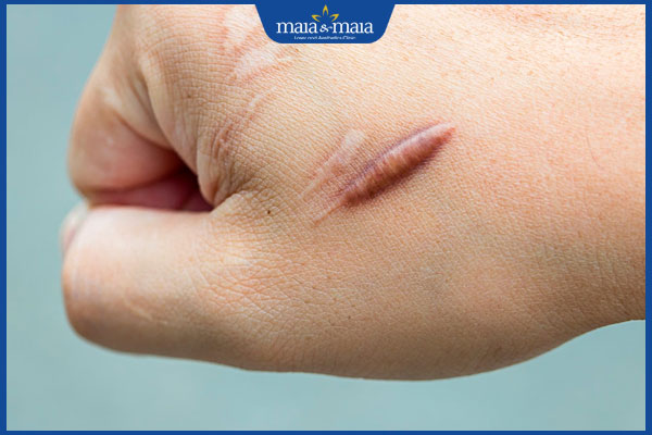 nguyên nhân bị sẹo lồi