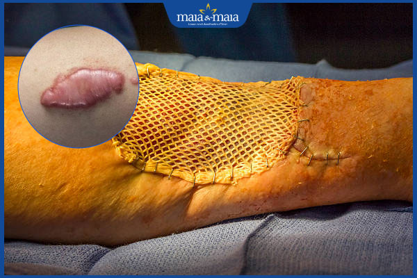 Ghép da trị sẹo lồi có tốt không? Quy trình và chi phí thực hiện 3 nhược điểm ghép da