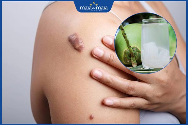 Uống nước dừa có bị sẹo lồi không? Lưu ý ngừa sẹo lồi 2 nước dừa không gây sẹo lồi