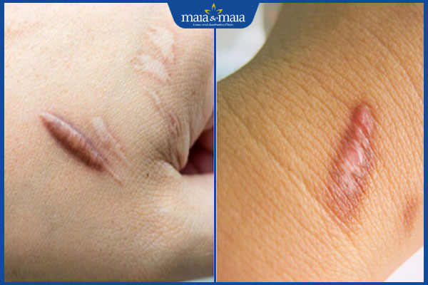 Giải đáp nhanh: Sẹo lồi và sẹo phì đại khác nhau như thế nào? 2 phân biệt sẹo lồi và sẹo phì đại