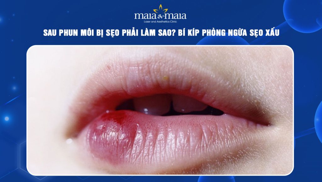 Sau phun môi bị sẹo phải làm sao? Bí kíp phòng ngừa sẹo xấu 1 phun môi bị sẹo