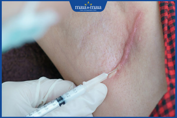 Đặc điểm sẹo lồi lâu năm và các phương pháp điều trị hiệu quả 3 phương pháp tiêm sẹo lồi