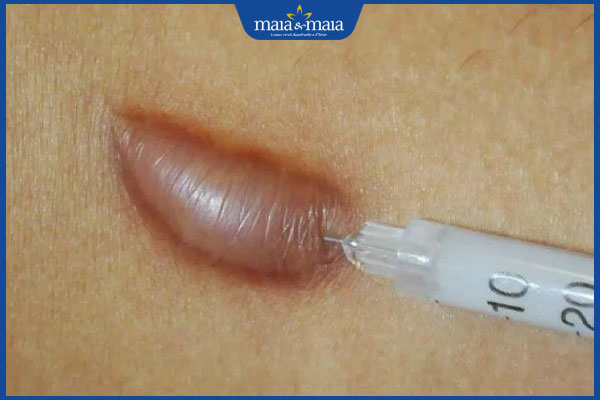 Tiêm sẹo lồi có tốt không? Quy trình và chi phí thực hiện 2 phương pháp tiêm sẹo lồi