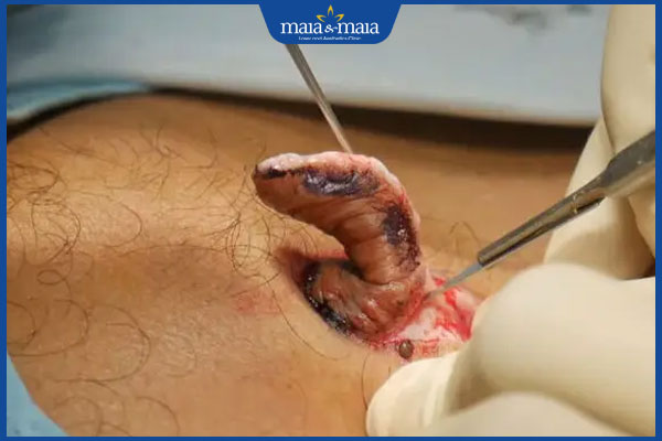 Đặc điểm sẹo lồi lâu năm và các phương pháp điều trị hiệu quả 4 quy trình cắt sẹo