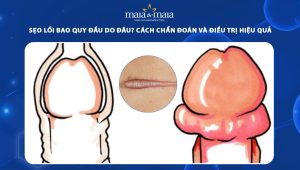 sẹo lồi bao quy đầu